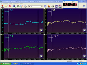 Physioflow case study : volume expander