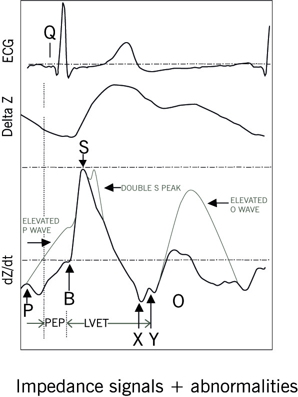 impedance signals abnormalities